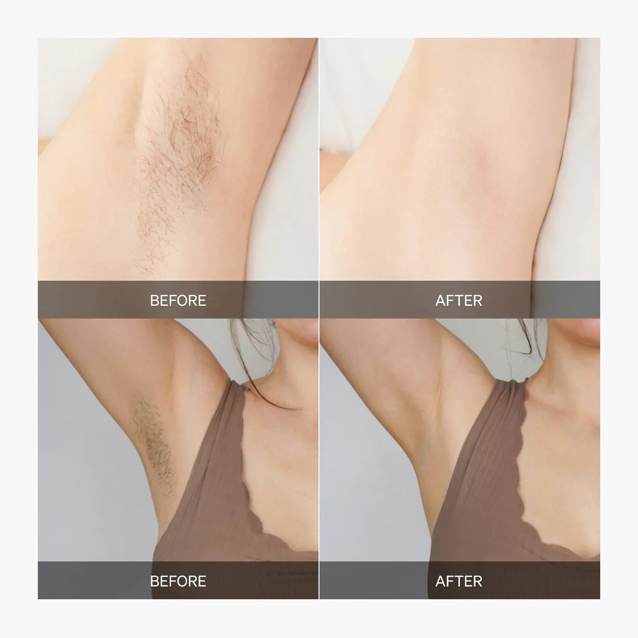 Aurest Laser Hair Remover