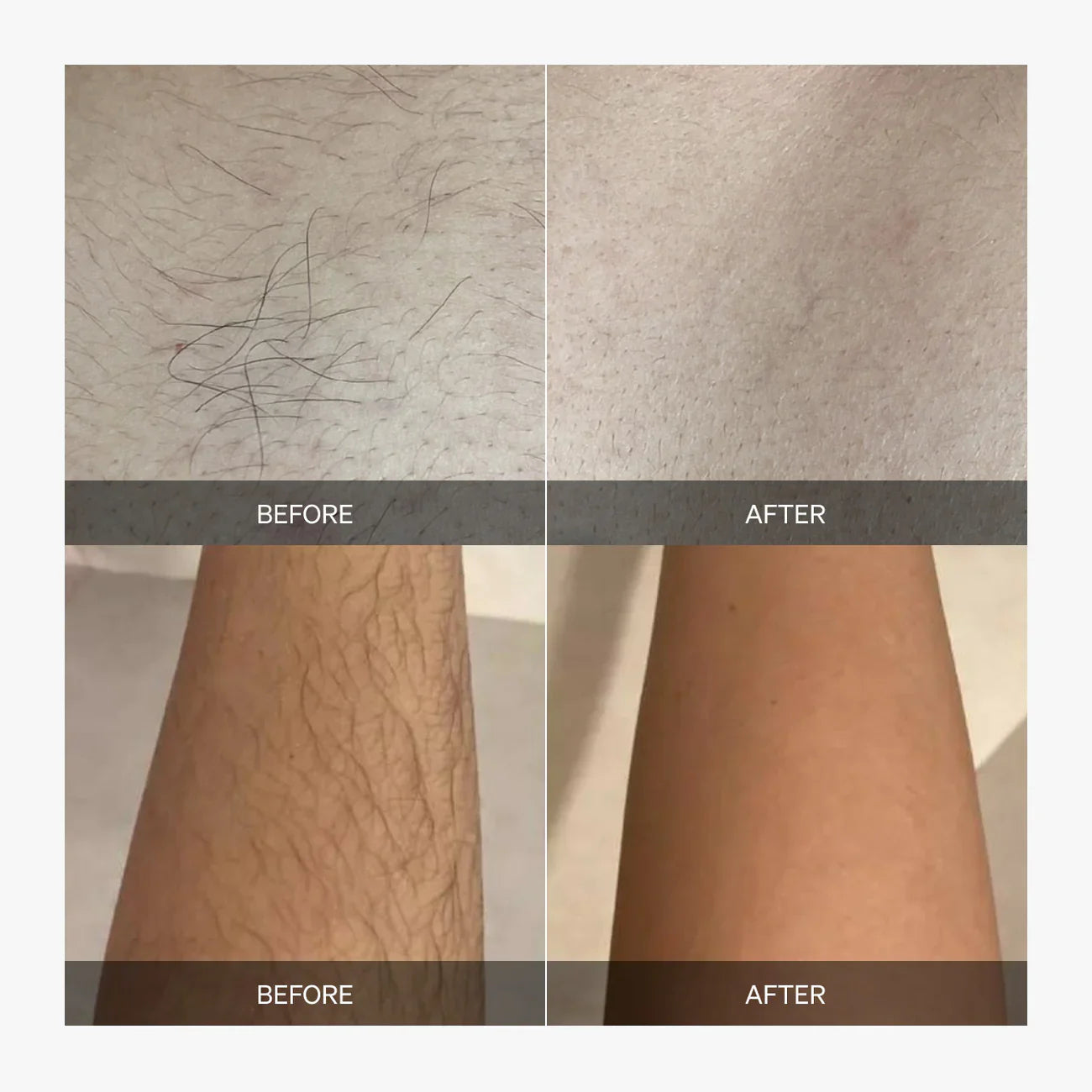 Aurest Laser Hair Remover